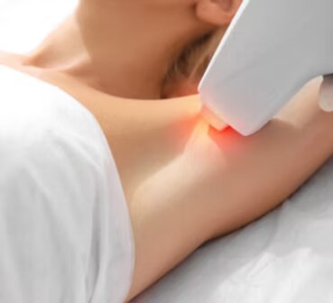 Épilation laser
